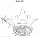 Fig. 11 - Nucleus replacement device and method