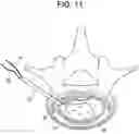 Fig. 12 - Nucleus replacement device and method