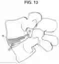 Fig. 14 - Nucleus replacement device and method