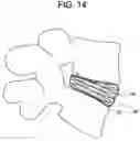 Fig. 15 - Nucleus replacement device and method