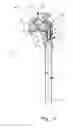 Fig. 03 - MODULAR SHOULDER PROSTHESIS WITH LOAD BEARING SURFACE