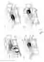 Fig. 02 - Device with a channel conducting a flowable medium and a method for removing inclusions