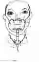 Fig. 05 - Face and tracheostomy nebulizing mask