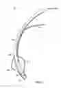 Fig. 02 - Endotracheal cuff and technique for using the same