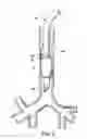 Fig. 03 - Endotracheal cuff and technique for using the same