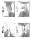 Fig. 16 - NASAL DEVICE APPLICATORS
