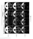 Fig. 07 - Fast self-calibrating radial sensitivity encoded image reconstruction using rescaling and preconditioning