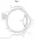 Fig. 02 - DEVICES AND METHODS FOR OPHTHALMIC DRUG DELIVERY