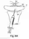 Fig. 52 - Devices for minimally invasive pelvic surgery