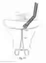 Fig. 55 - Devices for minimally invasive pelvic surgery