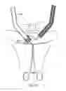 Fig. 59 - Devices for minimally invasive pelvic surgery