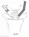 Fig. 62 - Devices for minimally invasive pelvic surgery