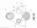 Fig. 19 - MECHANICAL DISTENSION SYSTEMS FOR PERFORMING A MEDICAL PROCEDURE IN A REMOTE SPACE