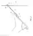 Fig. 03 - CONTINUOUS PASSIVE MOTION DEVICE FOR A TOE