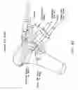 Fig. 49 - Method and apparatus for performing an open wedge, high tibial osteotomy
