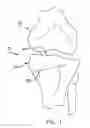 Fig. 02 - Method and apparatus for performing a high tibial, dome osteotomy