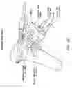 Fig. 49 - Method and apparatus for performing a high tibial, dome osteotomy