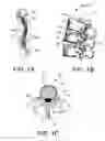 Fig. 02 - Guidance system,tools and devices for spinal fixation