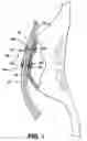 Fig. 02 - Segmented tissue-to-tissue anchoring device and method of using the same