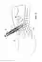 Fig. 07 - Endoscopic balloon tissue dissector and retractor