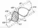 Fig. 01 - Endoluminal Filter With Fixation