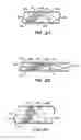 Fig. 03 - Endoluminal Filter With Fixation