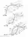 Fig. 05 - Endoluminal Filter With Fixation