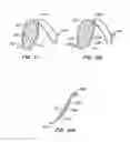 Fig. 09 - Endoluminal Filter With Fixation