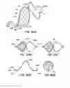 Fig. 47 - Endoluminal Filter With Fixation