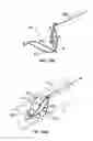 Fig. 69 - Endoluminal Filter With Fixation