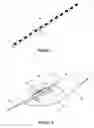 Fig. 02 - Clinical and surgical system and method for moving and stretching plastic tissue