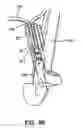 Fig. 67 - Surgical fastener