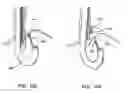 Fig. 79 - Surgical fastener