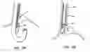 Fig. 80 - Surgical fastener