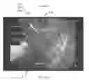 Fig. 82 - Surgical fastener