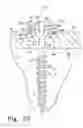 Fig. 11 - BONE PLATE SYSTEM WITH SLIDABLE COMPRESSION HOLES