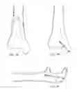 Fig. 08 - Bone screw system and method