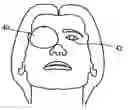 Fig. 01 - Device and method for stabilization of eye during eye surgery