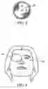 Fig. 04 - Device and method for stabilization of eye during eye surgery