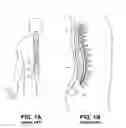 Fig. 02 - GROUPED LEADS FOR SPINAL STIMULATION