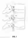 Fig. 07 - GROUPED LEADS FOR SPINAL STIMULATION