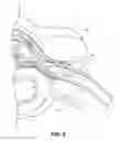 Fig. 08 - GROUPED LEADS FOR SPINAL STIMULATION