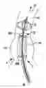 Fig. 01 - System for in situ positioning of cardiac valve prostheses without occluding blood flow