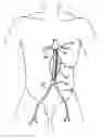Fig. 01 - Intraluminal Graft