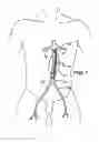 Fig. 02 - Intraluminal Graft