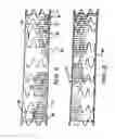 Fig. 03 - Intraluminal Graft