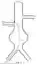 Fig. 02 - Prosthesis Deployment Apparatus and Methods