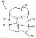Fig. 01 - Vertebral implant containment device and methods of use