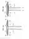Fig. 06 - Implantable repair device