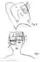 Fig. 04 - Therapy pad used on a head